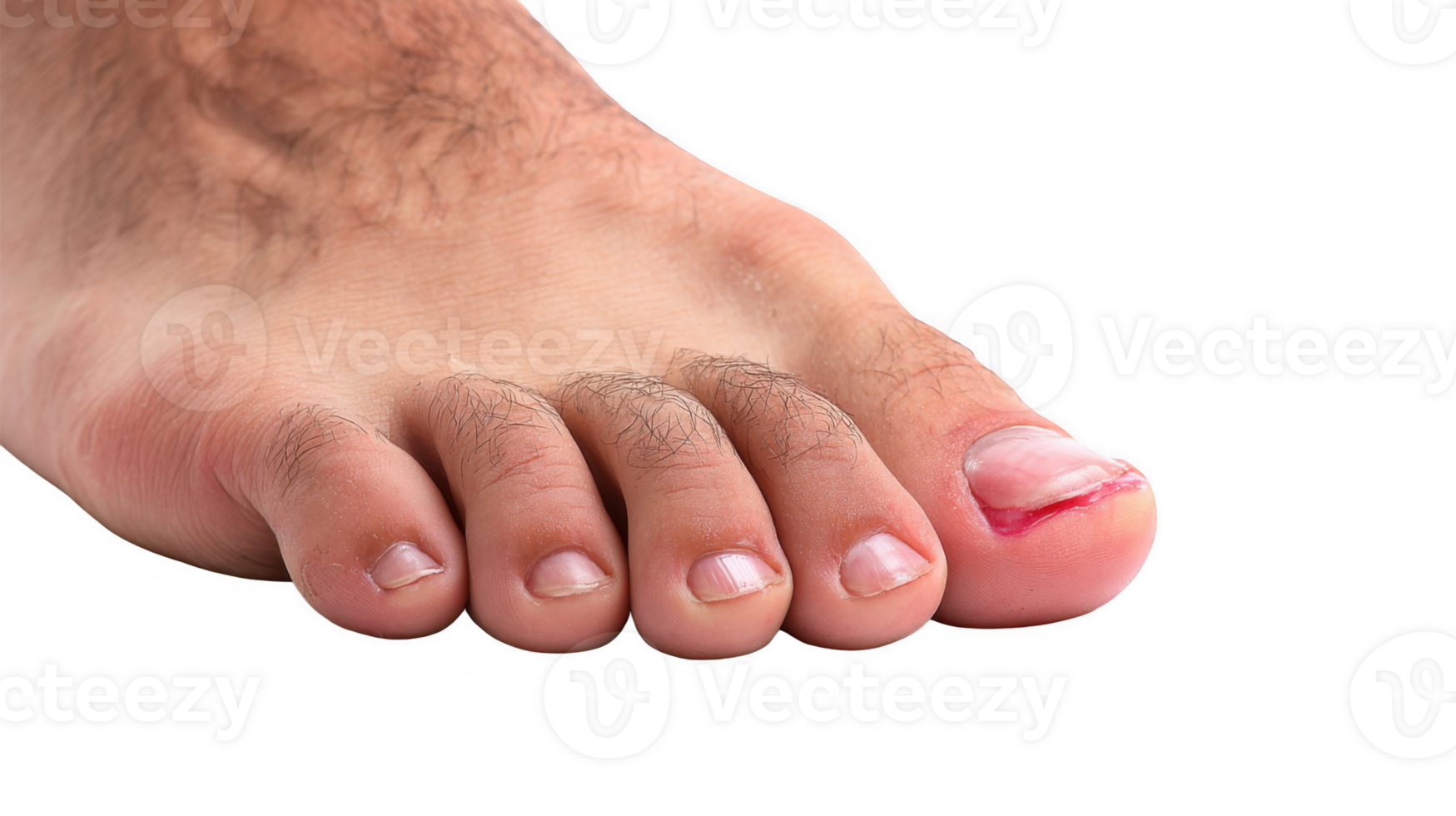 Ingrown toenail causing pain and discomfort on transparent background png