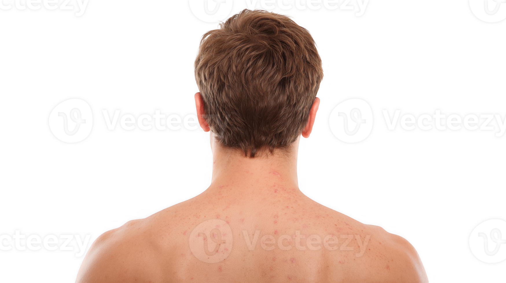 Man showing acne on his back on transparent background png