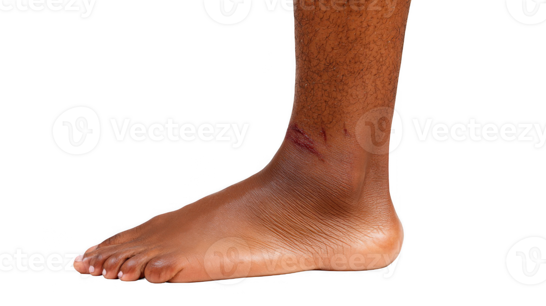 Bruised shin showing skin lesion on transparent background png