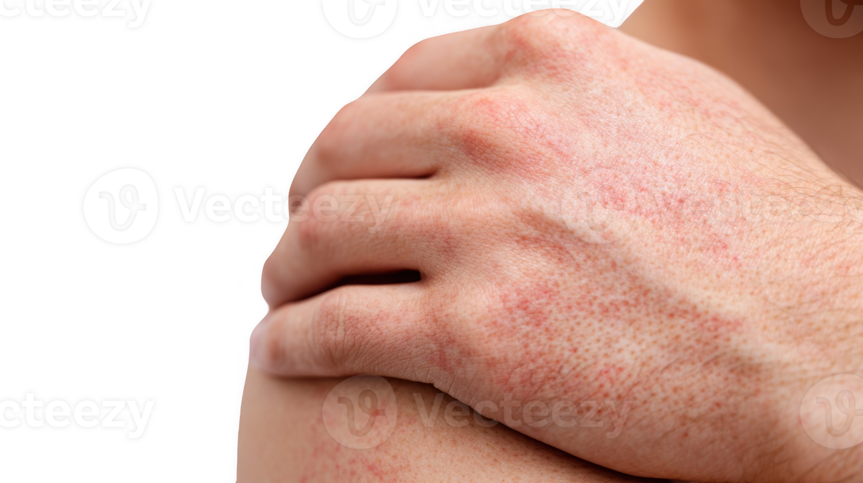 Man suffering from dermatitis is scratching his shoulder with red rash on transparent background png