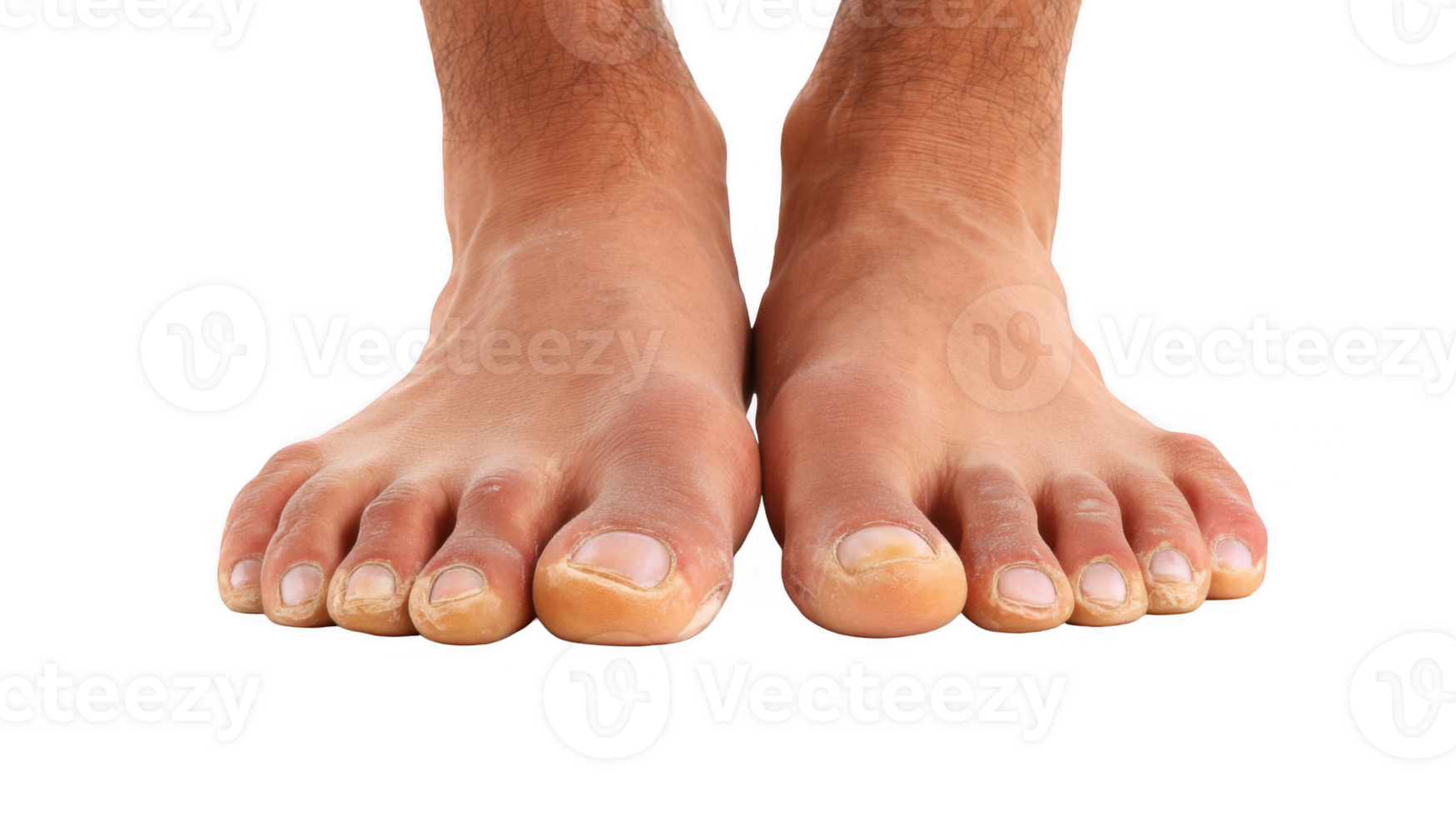 Man showing discolored toenails on transparent background png