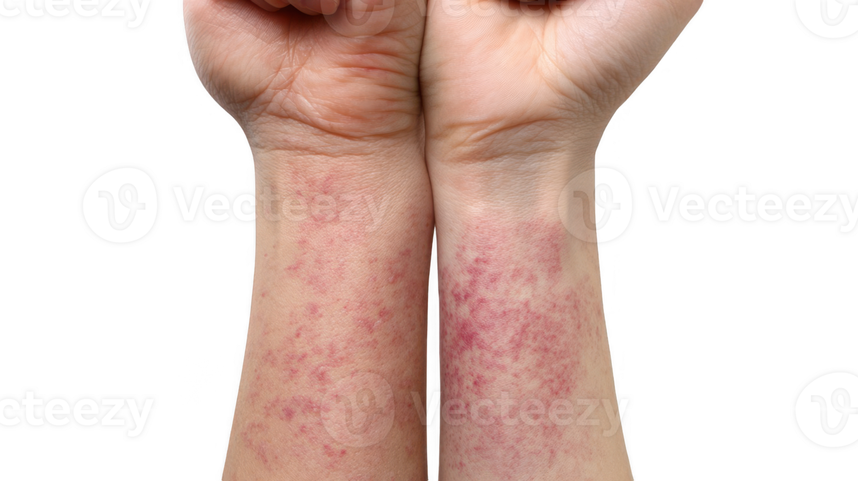 Patient showing red rash on wrists, transparent background png