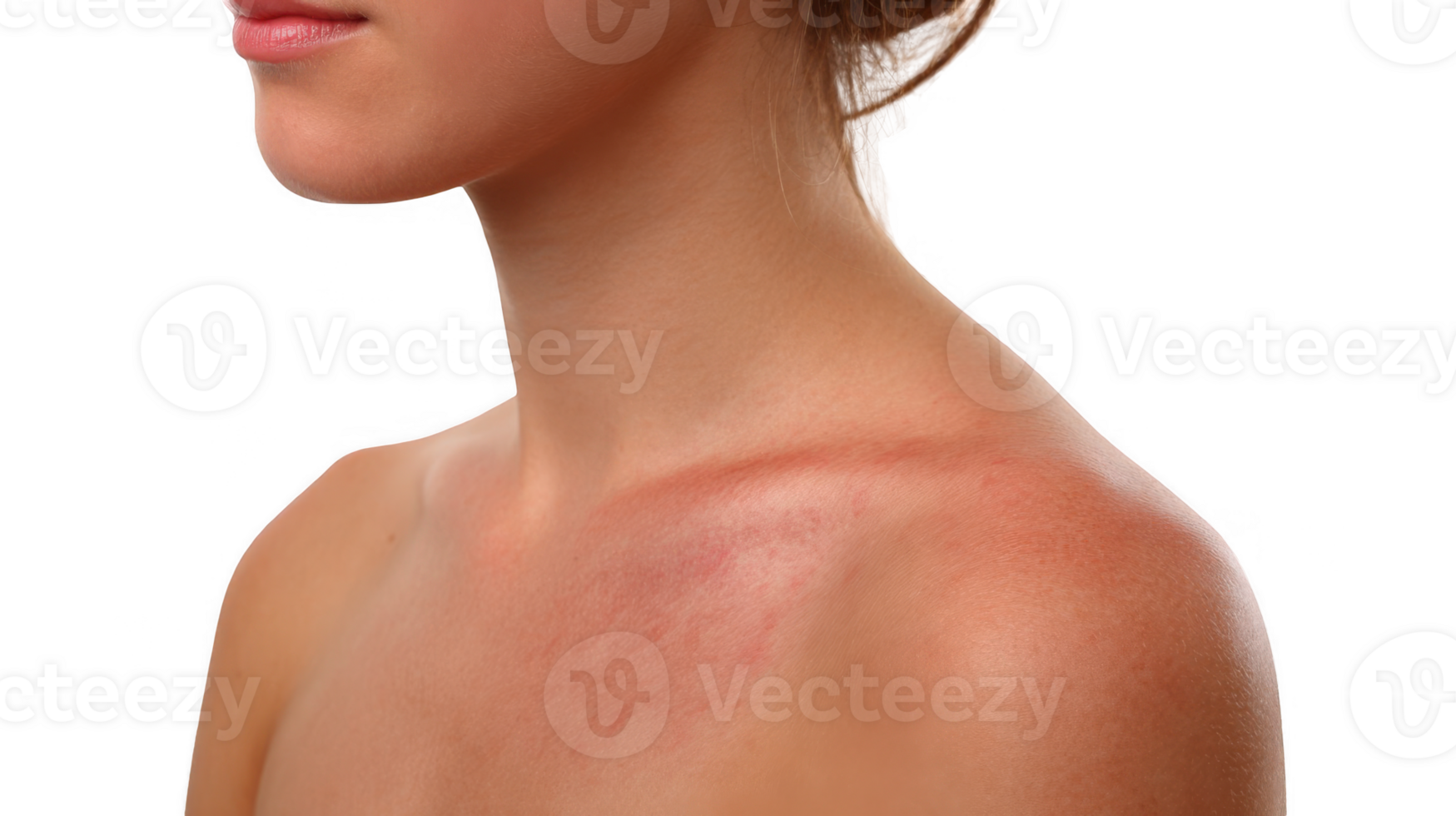 Woman showing mild sun rash on shoulder on transparent background png