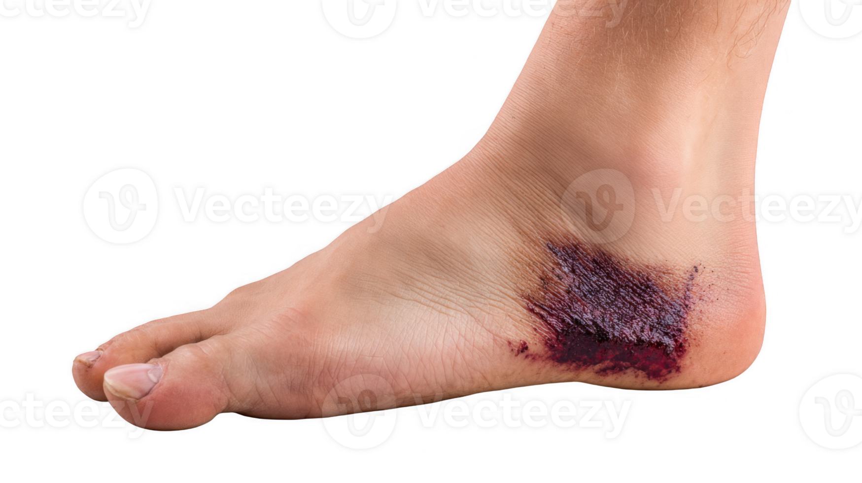 Close up of bruise on injured heel showing skin damage png