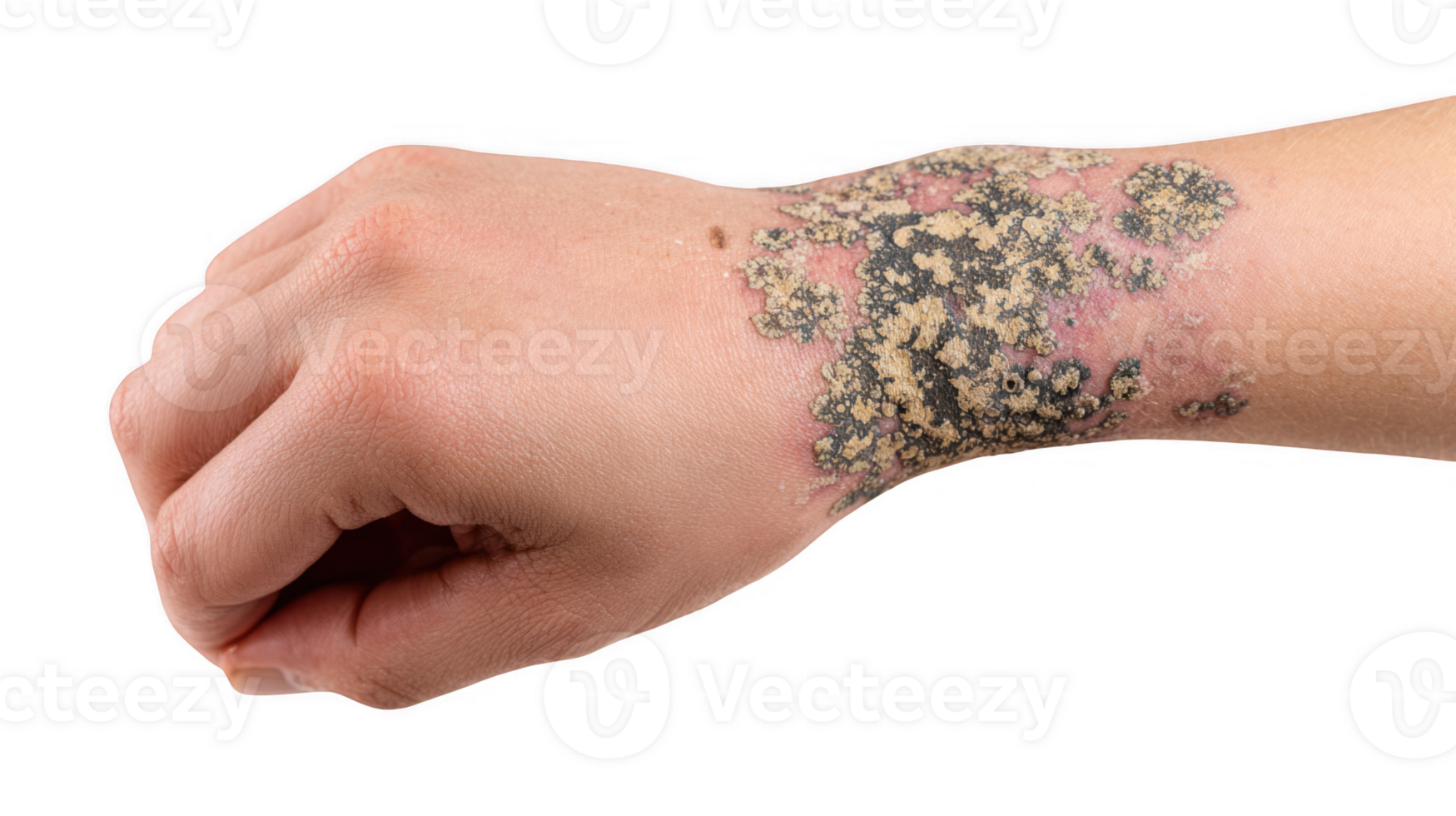 Lichen planus showing skin manifestations on wrist with transparent background png