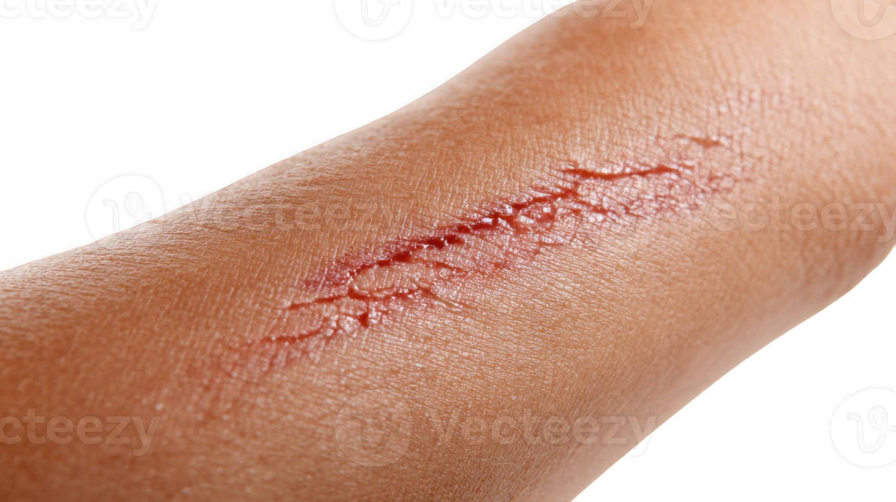 Closeup of deep scratch wound healing on human arm on transparent background png