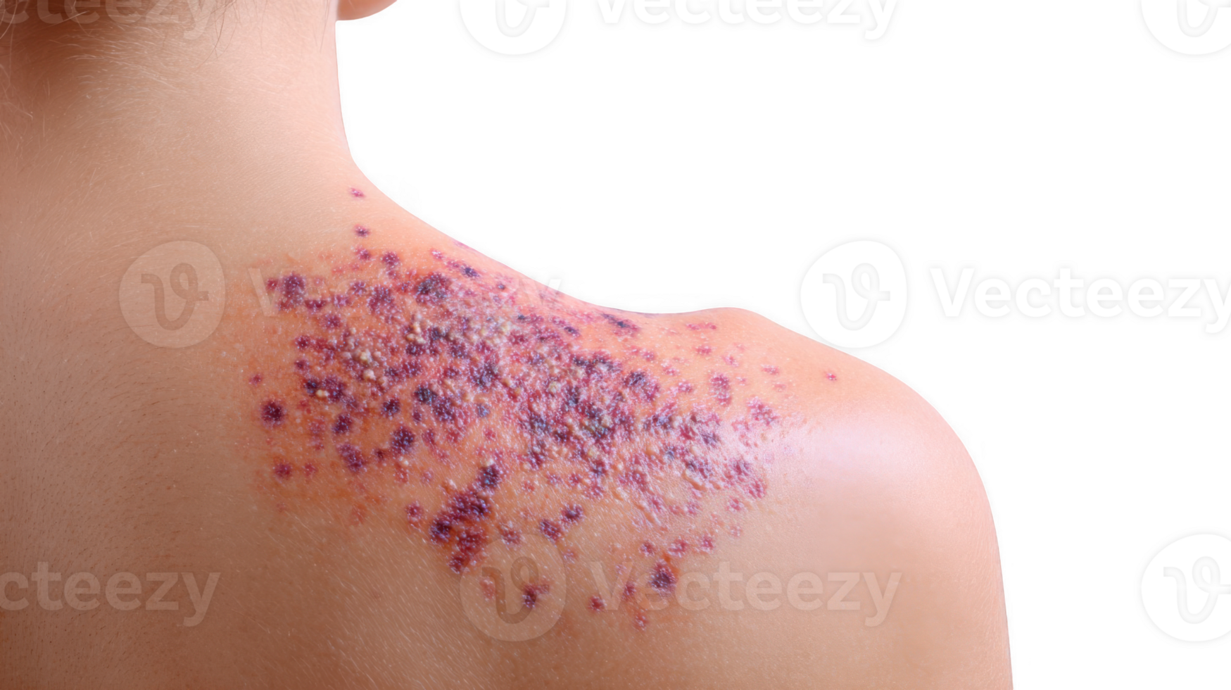Shingles showing symptoms on back skin with transparent background png