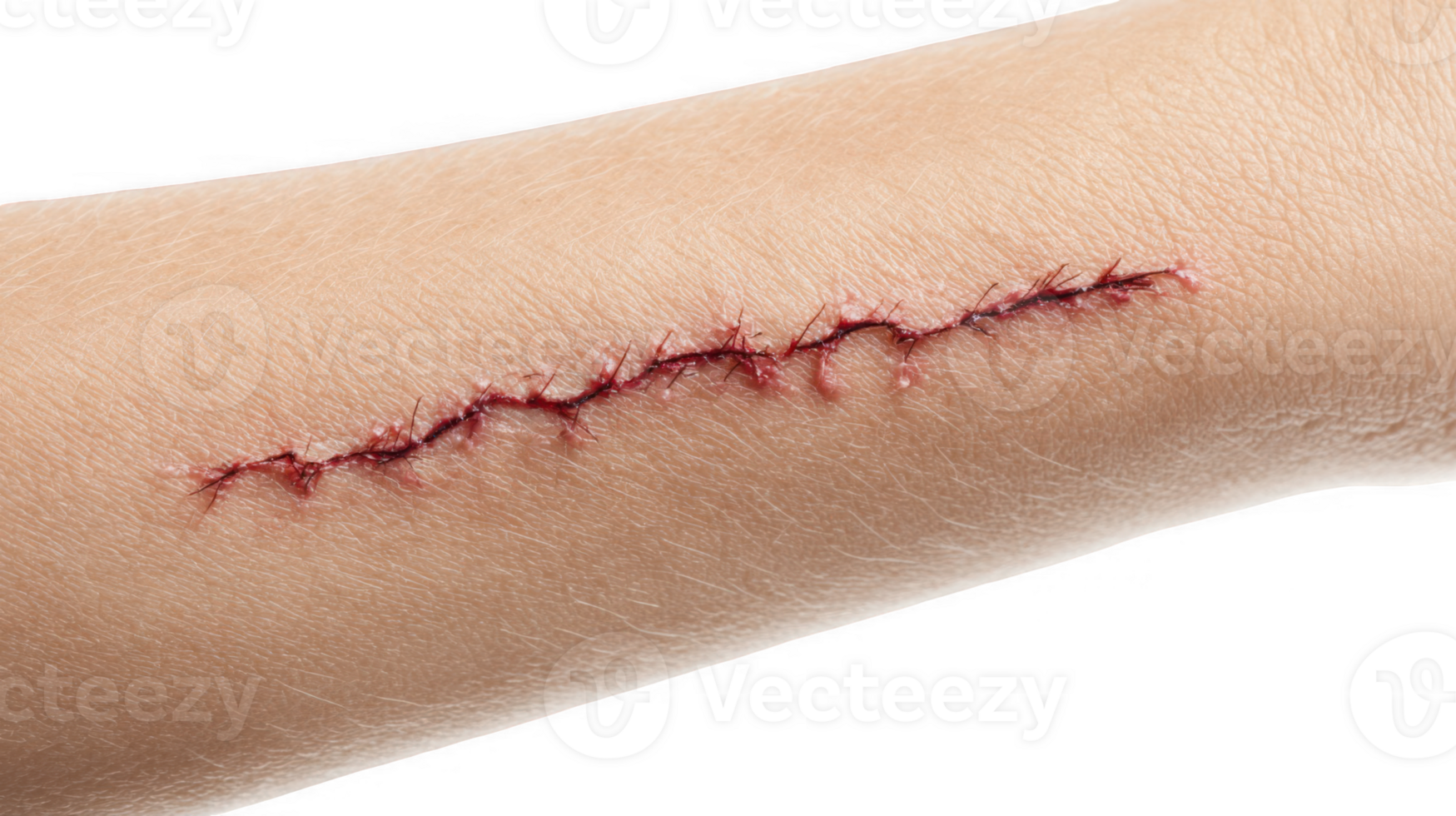 Fresh surgical scar showing stitches on forearm with transparent background png
