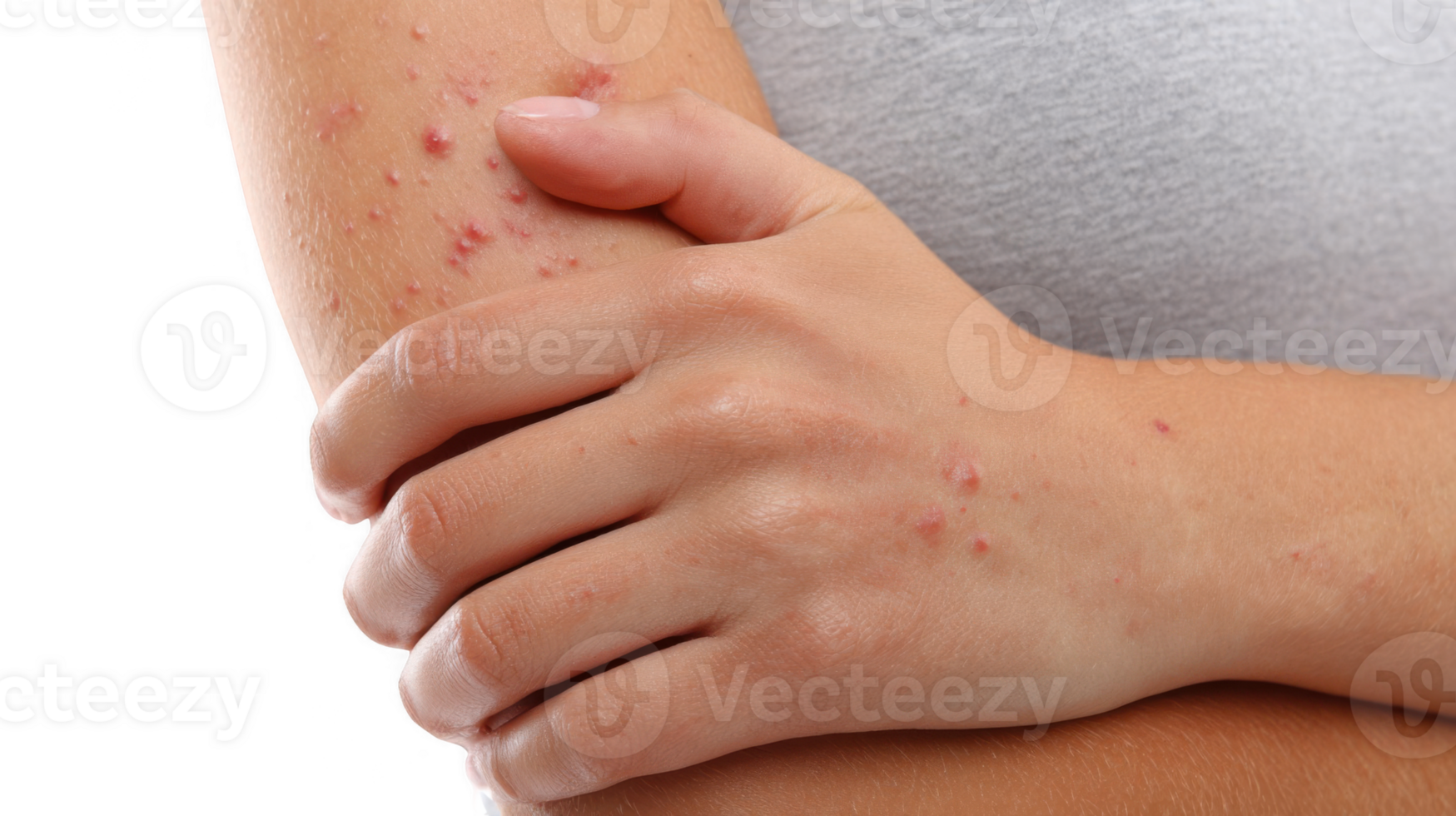 Woman holding itching arm with allergy symptoms on transparent background png