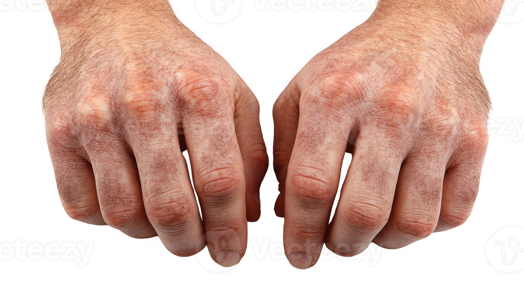 Two hands showing hyperpigmentation on transparent background png