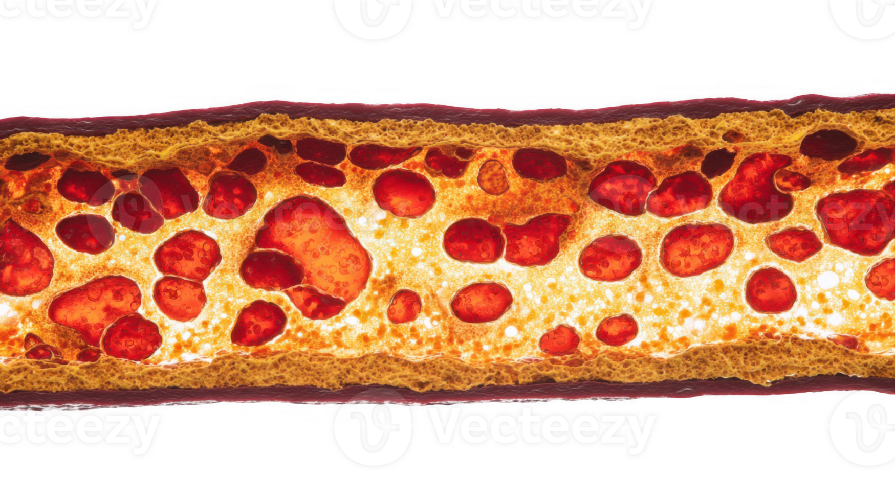 Clogged artery showing atherosclerosis and cholesterol buildup with transparent background png