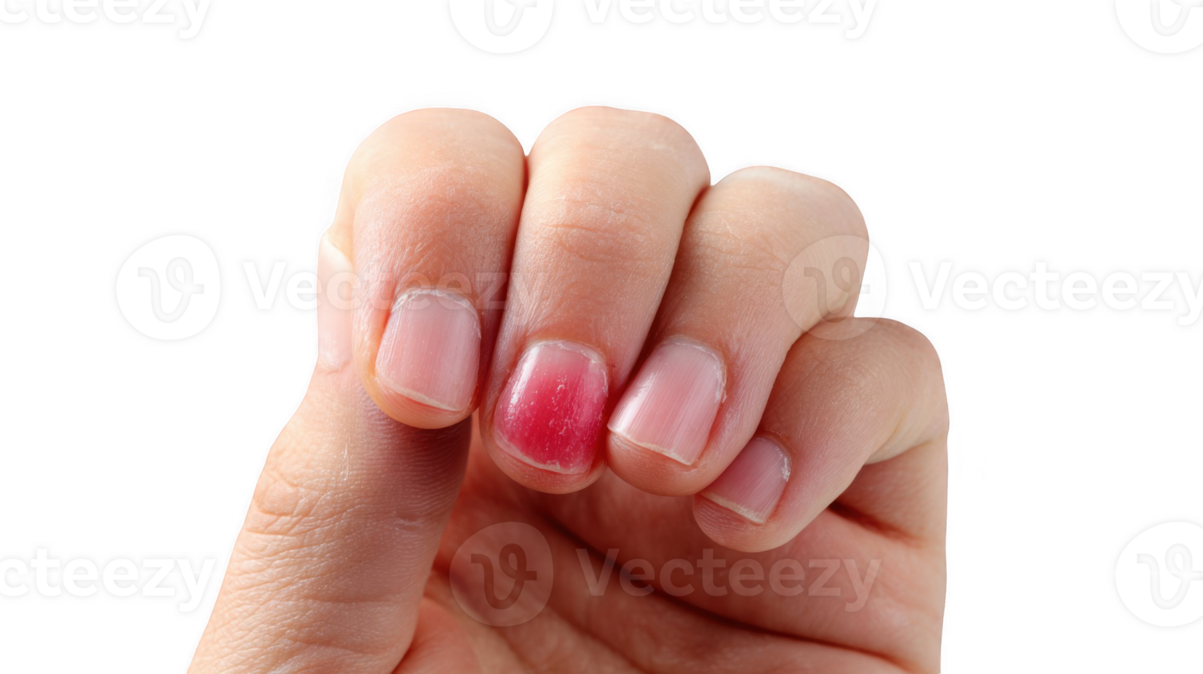 Close up of bruised fingernail showing subungual hematoma on transparent background png