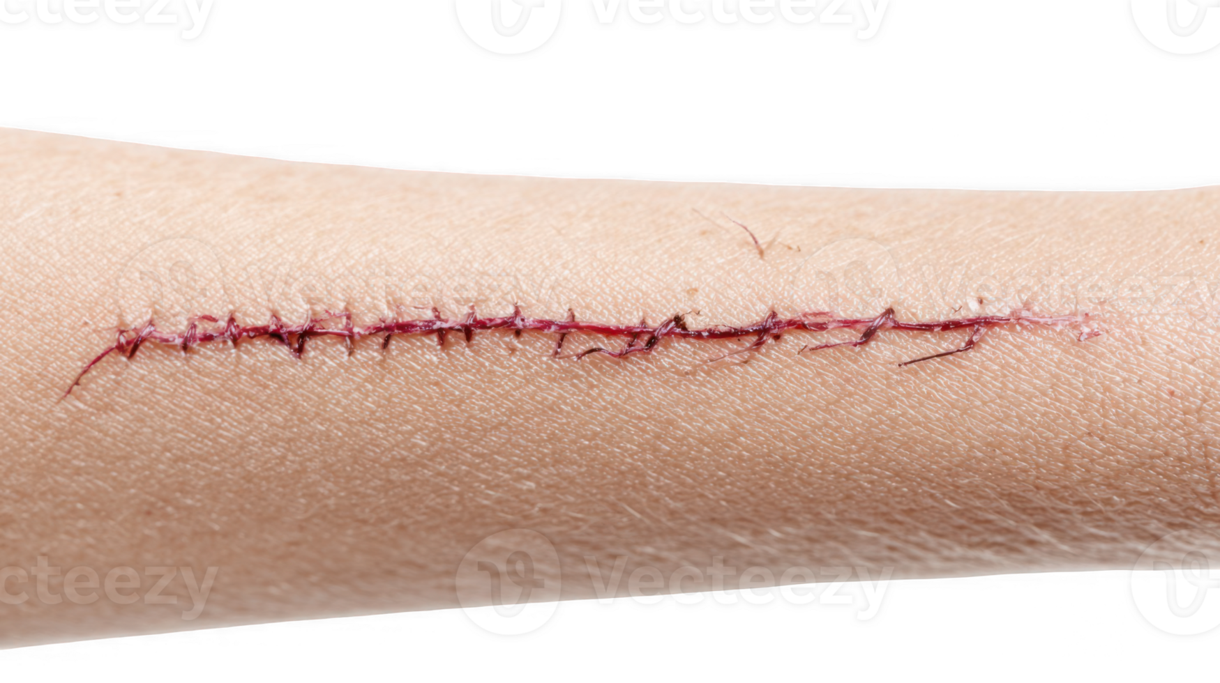 Surgical scar showing stitches on transparent background png