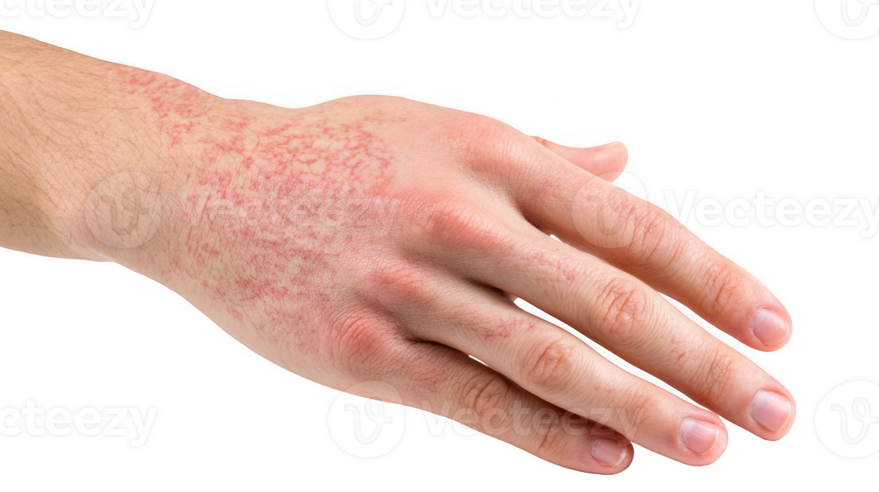 Eczema affecting hand and wrist showing redness and irritation on transparent background png