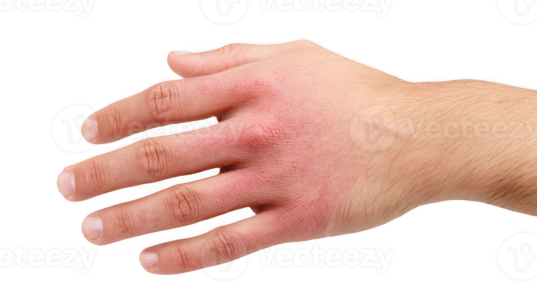 Man showing contact dermatitis symptoms on transparent background png