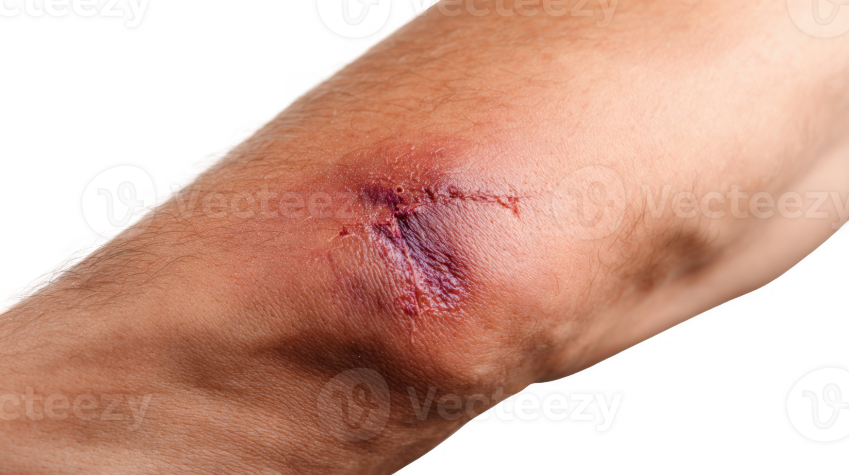 Close up of deep bruise and scar on elbow with transparent background png