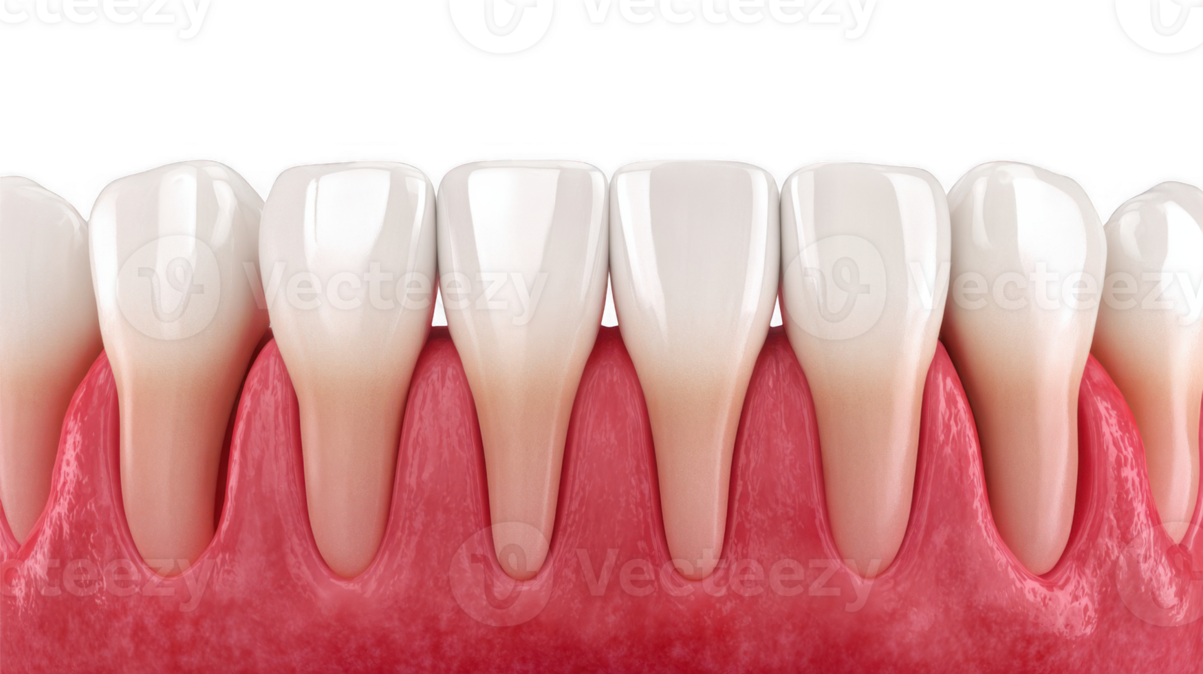 Swollen gums showing gingivitis and healthy white teeth on transparent background png