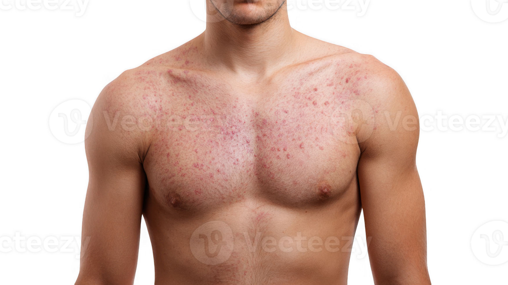 Man showing measles rash on chest and shoulders on transparent background png