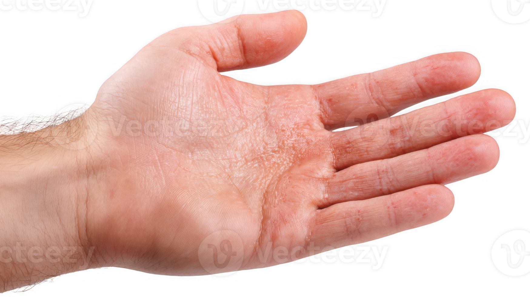 Hand showing blisters and dry skin on palm with transparent background png