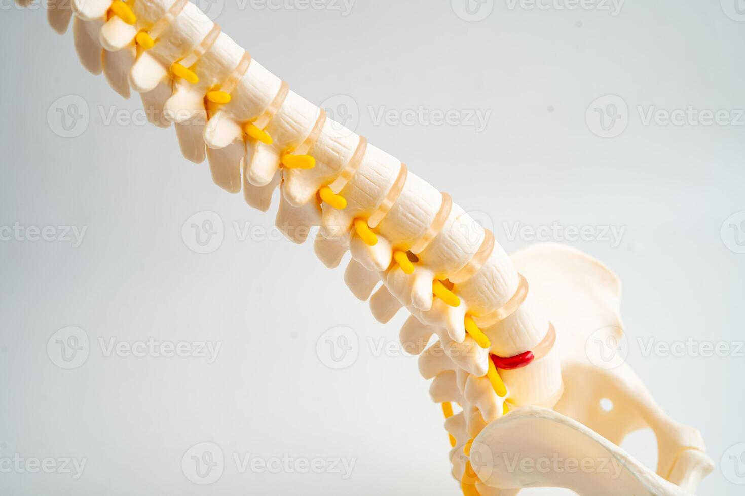 Lumbar spine displaced herniated disc fragment, spinal nerve and bone. Model treatment photo