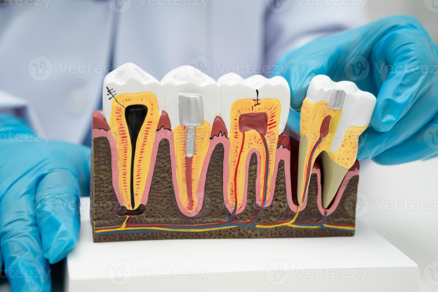 dentist holding dental implant, artificial tooth roots into jaw, root canal of dental treatment, gum disease, teeth model photo