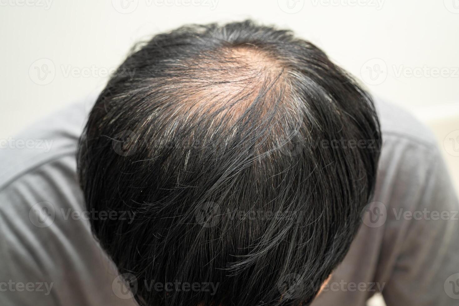 Bald in the middle head and begin no loss hair glabrous of business photo