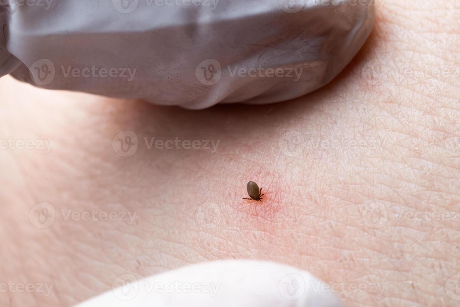 Sucking tick Macro photo on human skin. Ixodes ricinus. Bloated parasite bitten into pink irritated epidermis. Small red drops. Dangerous insect mite. Encephalitis, Lyme disease infection