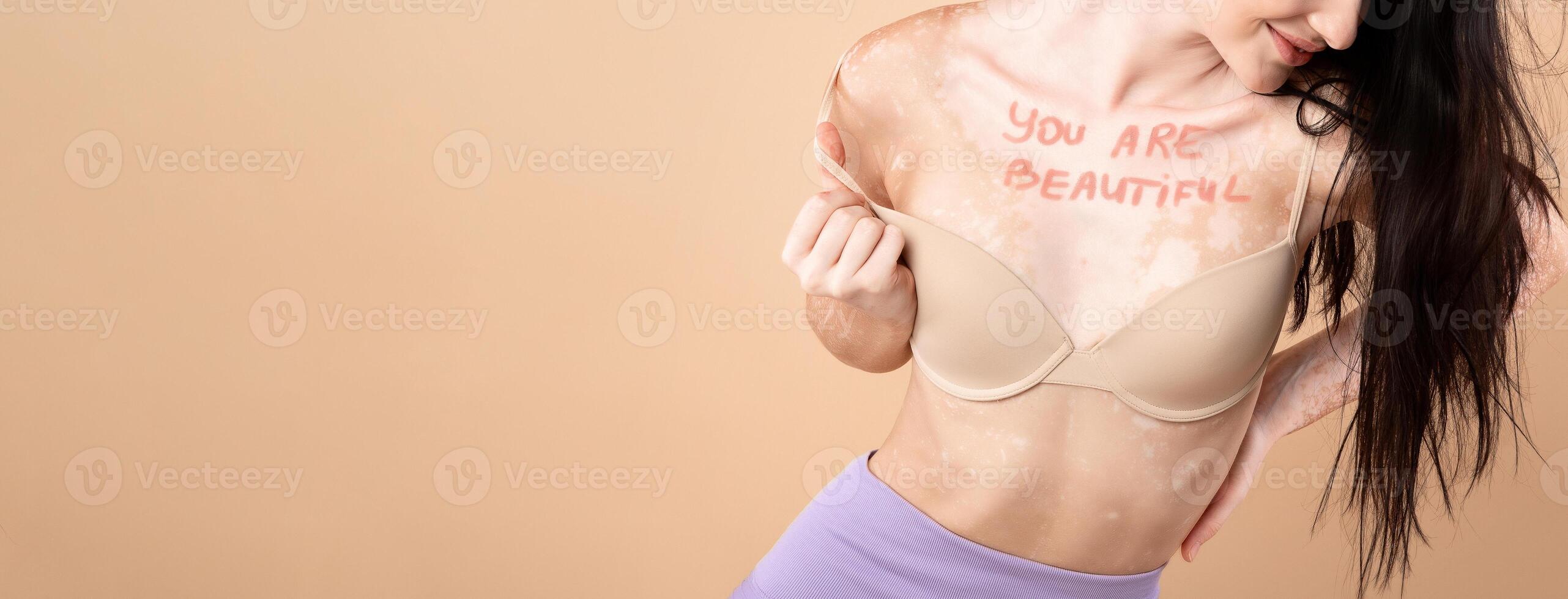 Woman With Vitiligo Skin Disorder With You Are Beautiful Motivational Inscription On Her Chest Posing In Underwear Over Beige Studio Background, Young Attactive Female Enjoying Natural Beauty, Closeup photo