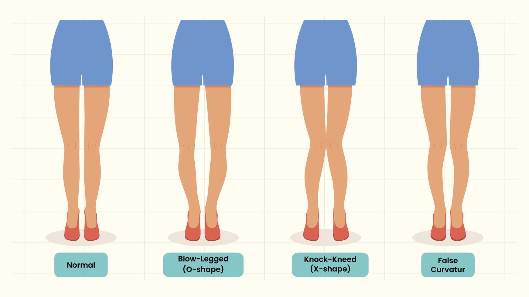 Illustration of Different Womens Leg Shapes Showing Normal and Abnormalities vector