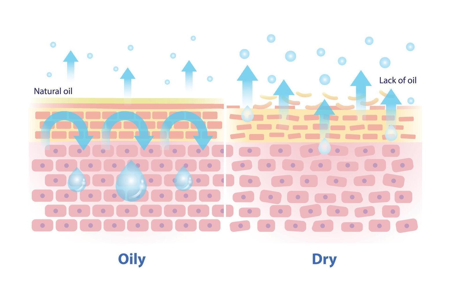 The mechanism of oily and dry skin illustration. Comparison of natural oil on skin layer acts as an occlusive, less transepidermal water loss. And lack of oil on skin causes more TEWL. vector