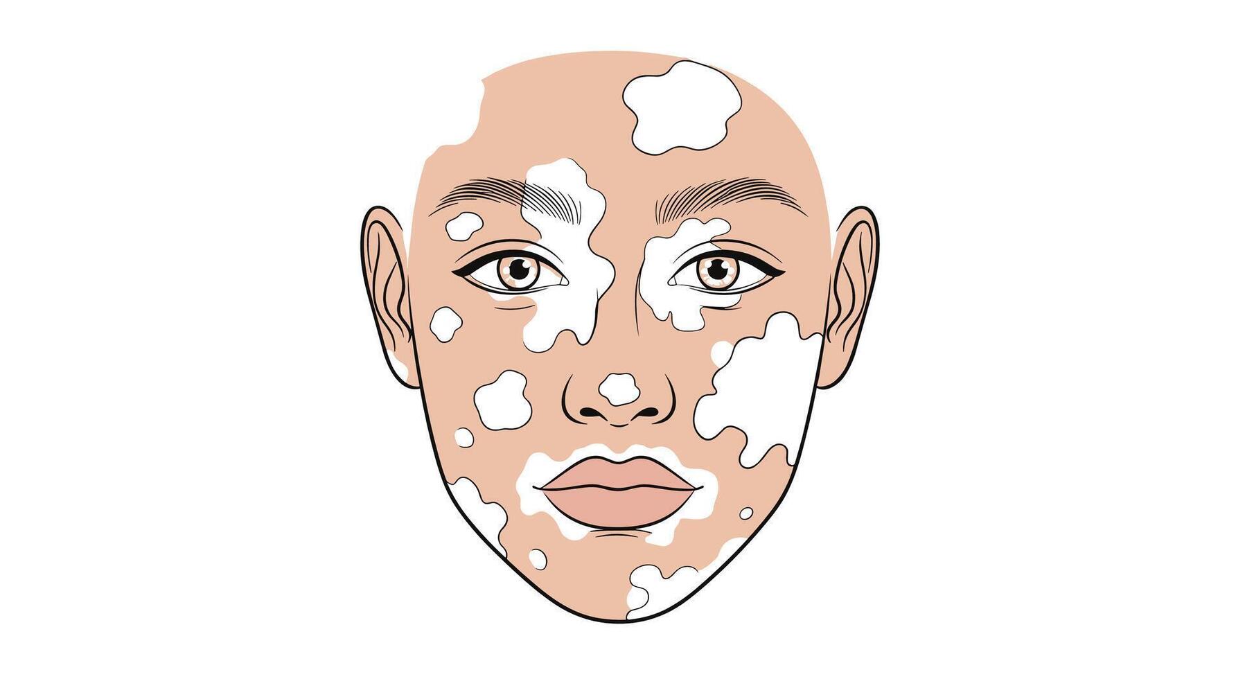 Understanding Vitiligo Causes Symptoms Diagnosis Treatment and Coping Strategies To Manage This Skin Condition vector