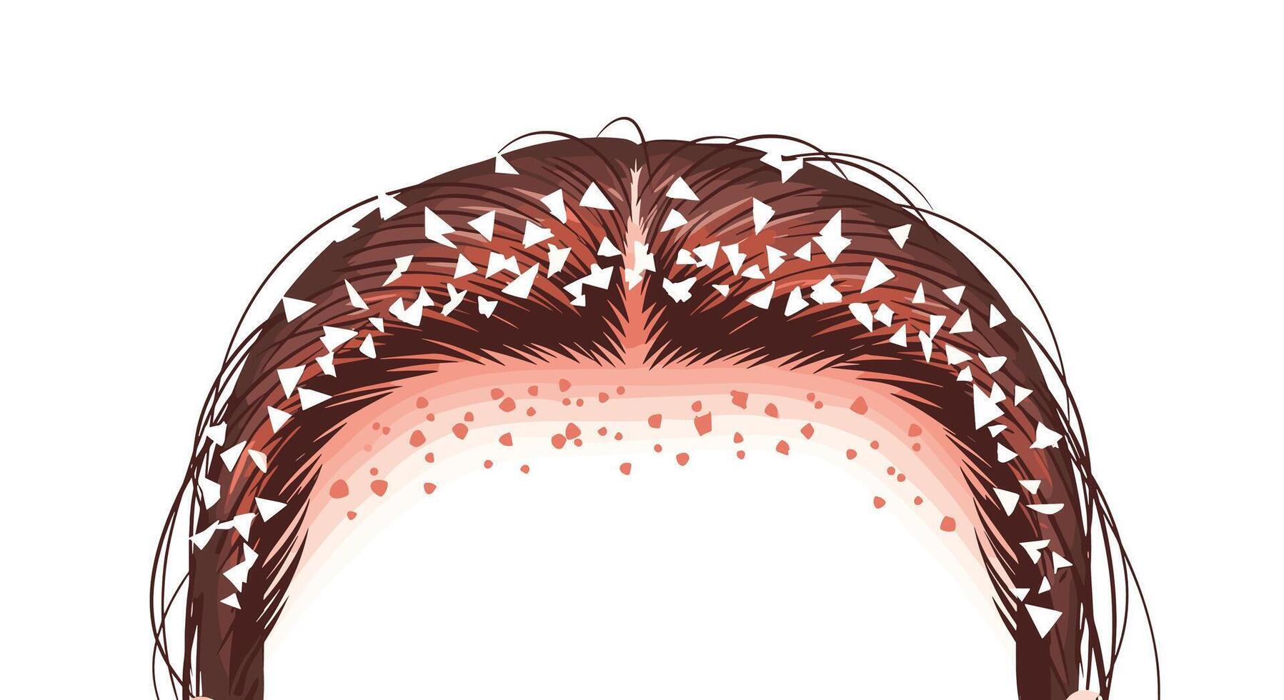 Understanding Dandruff Prevention and Treatment A Guide to Scalp Health and Relief vector