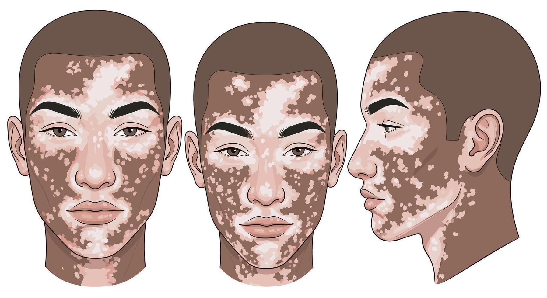 Understanding Vitiligo A Comprehensive Guide to Causes Symptoms and Treatment Options Available vector