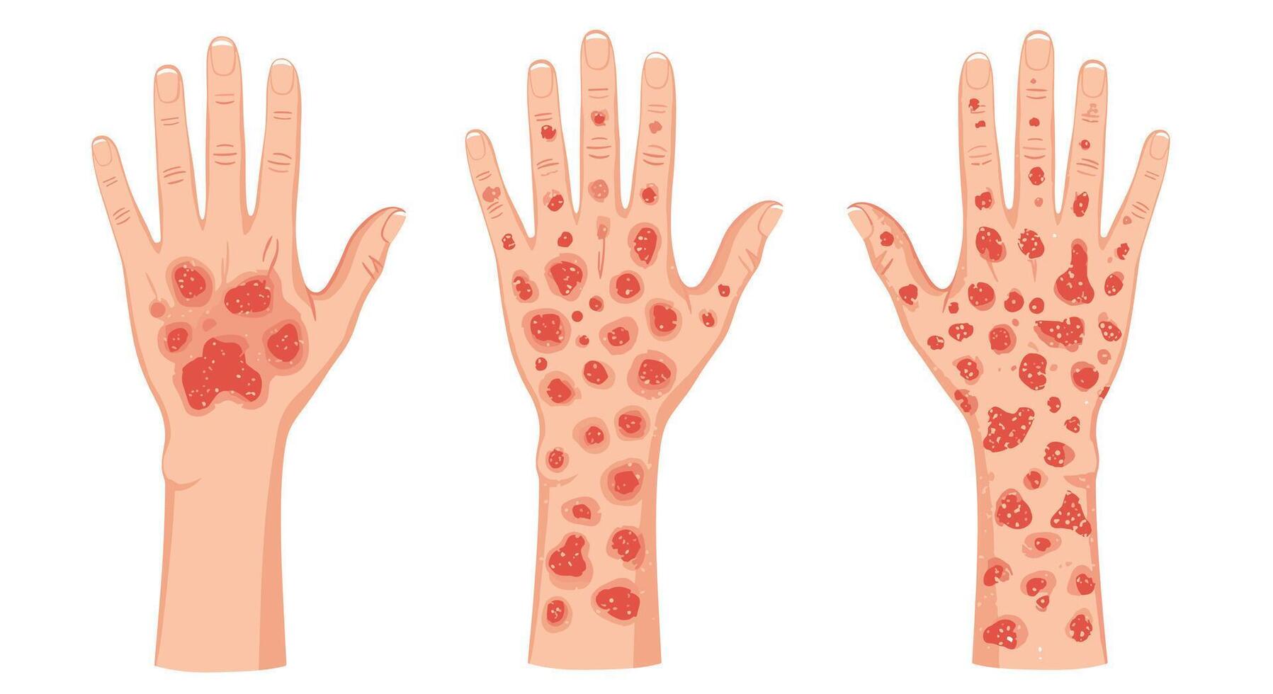 Skin Rash Identification And Diagnosis Understanding Various Types of Skin Rashes on Hand vector