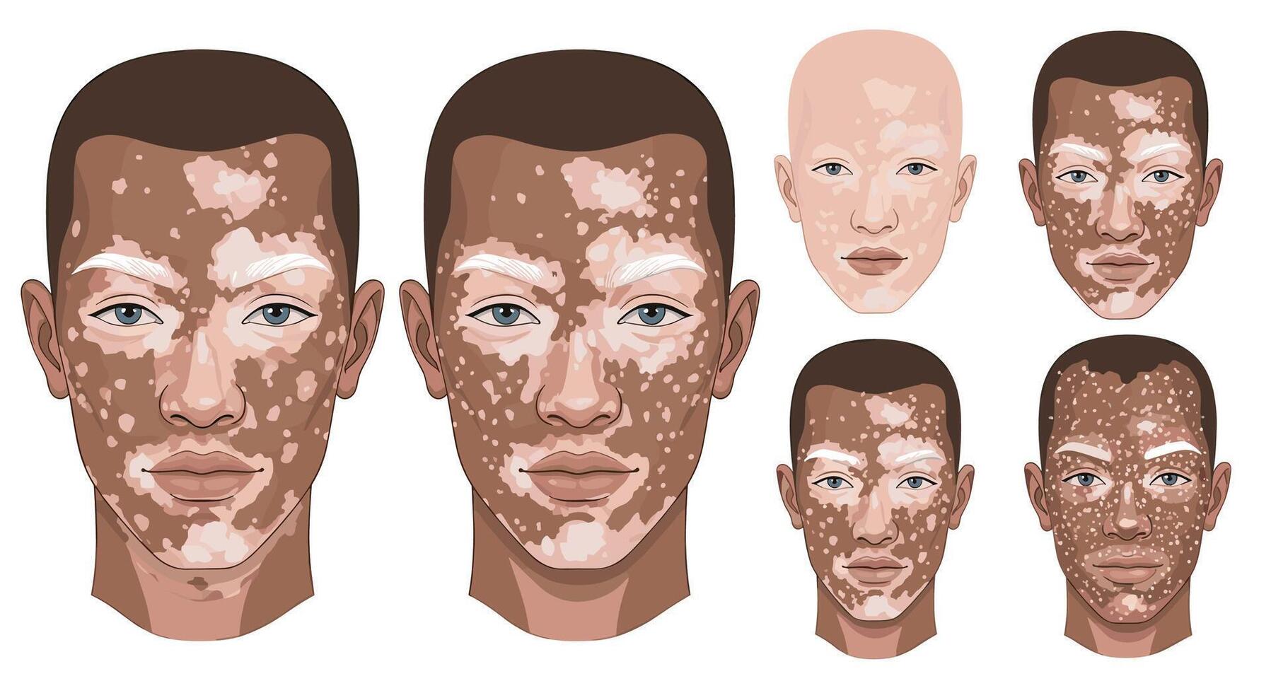 Understanding Vitiligo The Skin Condition and Its Psychological Impact On Affected People vector