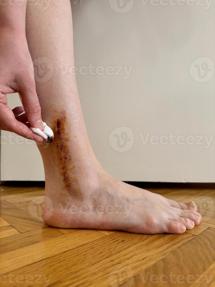 Close-up photo of healing post-surgical scar on the right ankle with of iodine solution applied with a cotton swab. Concept of wound care, disinfection, and recovery after surgery.
