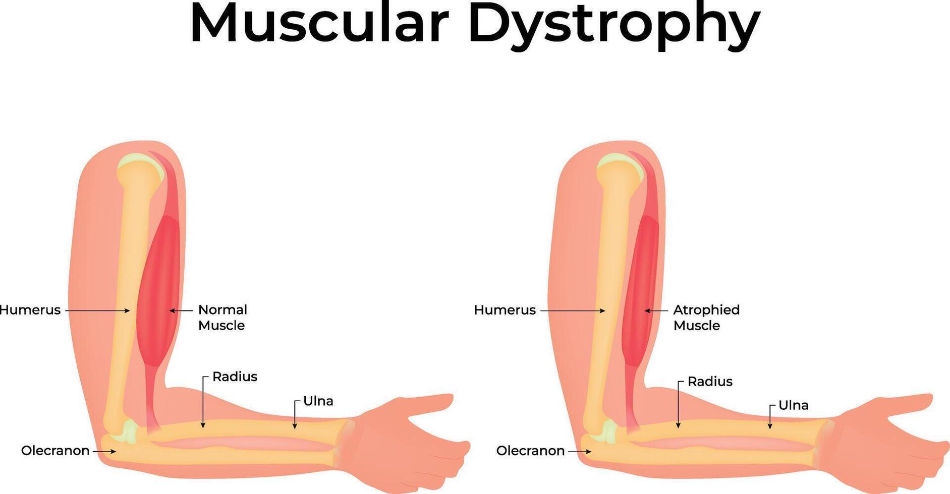 Muscular Dystrophy Arm Muscle Atrophy Design Illustration Diagram vector