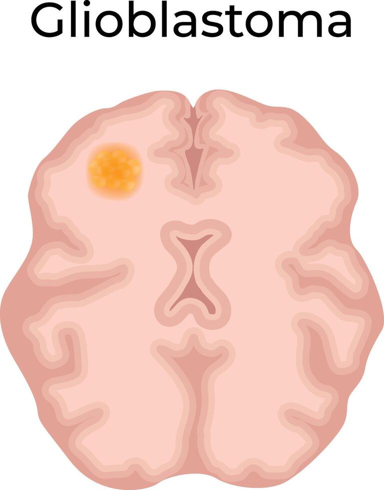 Glioblastoma Brain Tumor Illustration vector
