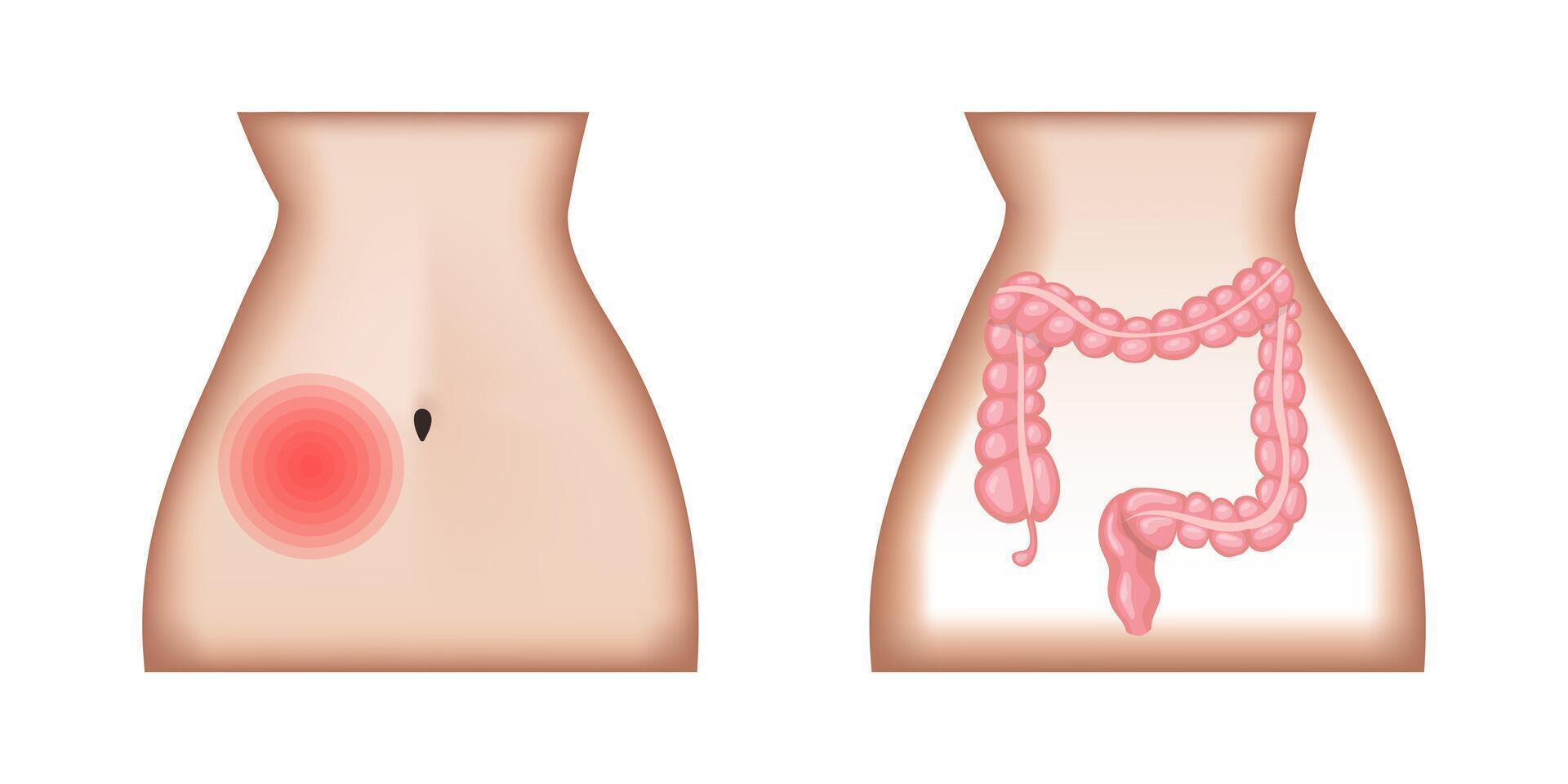 Medical illustration showing location of pain in the lower right abdominal quadrant and inflamed appendix, a condition known as appendicitis vector