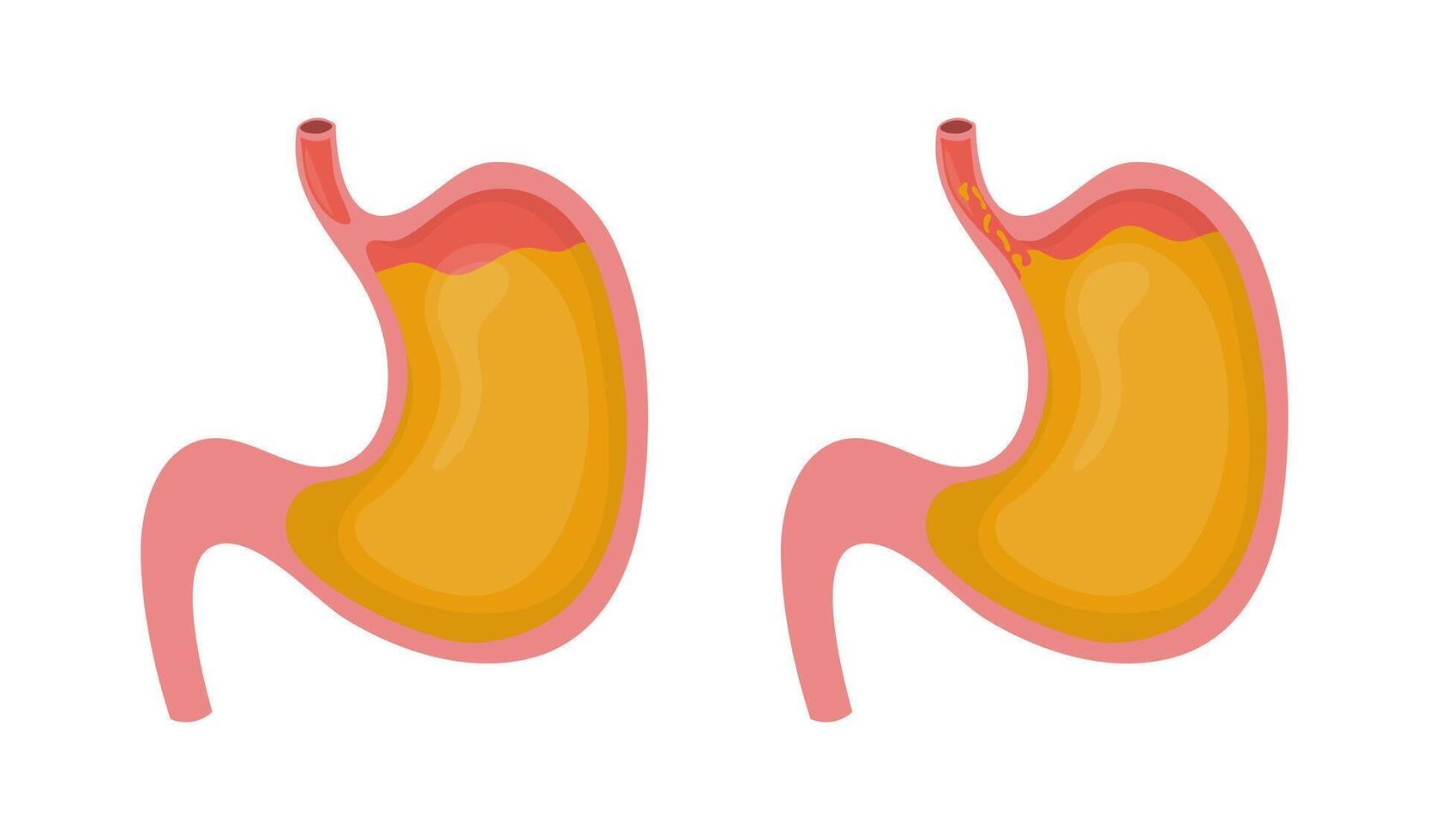 Stomach with gastric juice and stomach with gastroesophageal reflux disease showing acid reflux entering esophagus, causing heartburn, medical and healthcare educational vector