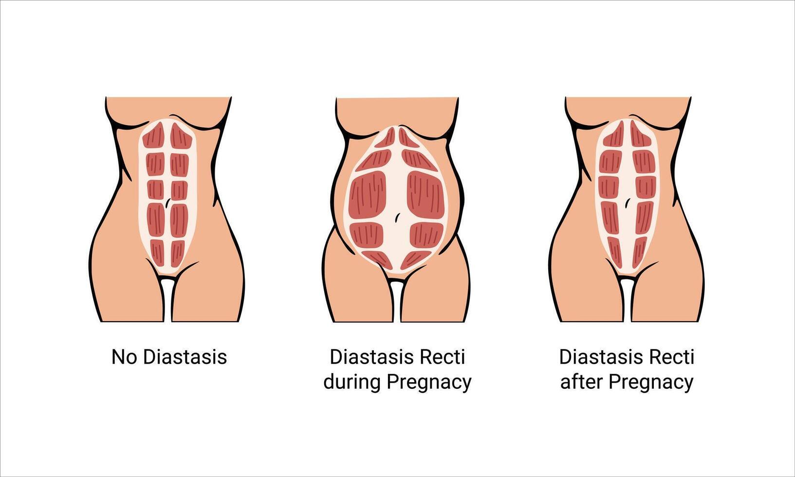 Diastasis recti stages during pregnancy vector