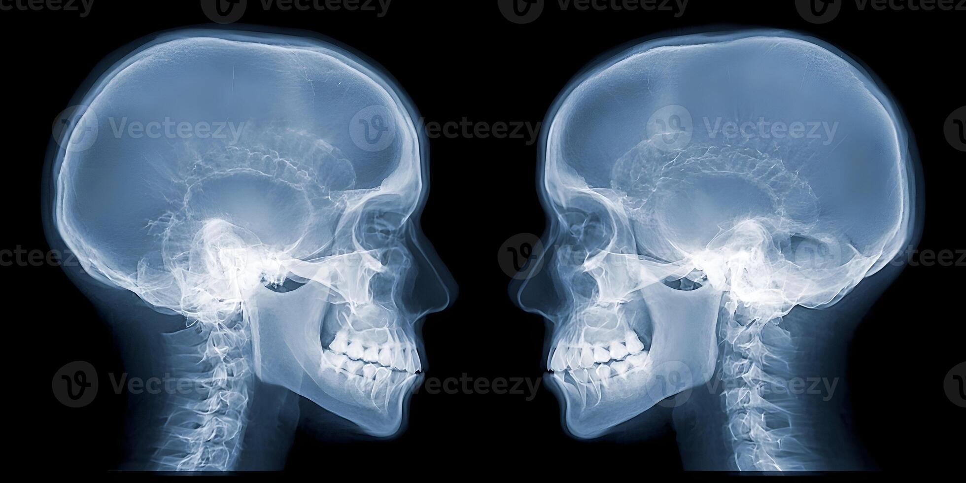 Two Human Skulls XRay Side Profile Facing Each Other Medical Anatomy Image photo
