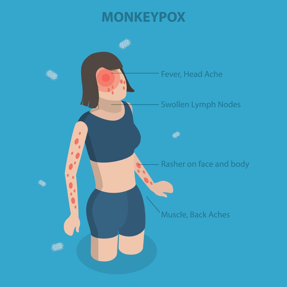 3D Isometric Flat Conceptual Illustration of Monkeypox Virus Symptom, Infectious Disease vector