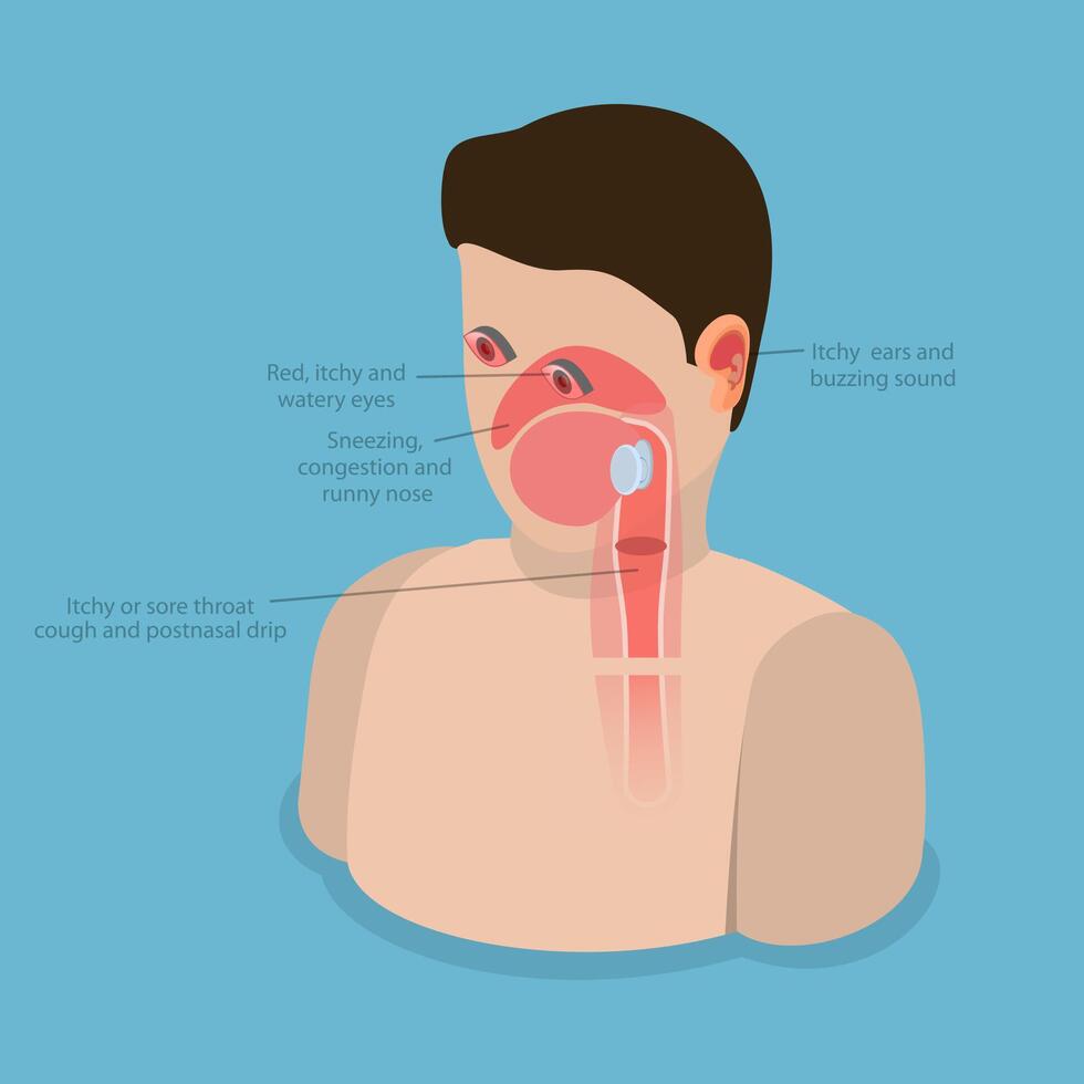 3D Isometric Flat Conceptual Illustration of Allergic Rhinitis, Labeled Educational Diagram vector