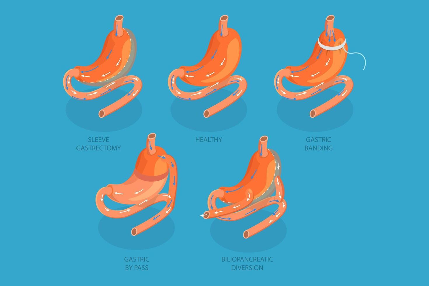 3D Isometric Flat Conceptual Illustration of Types Of Bariatric Surgery, Sleeve Gastrectomy vector