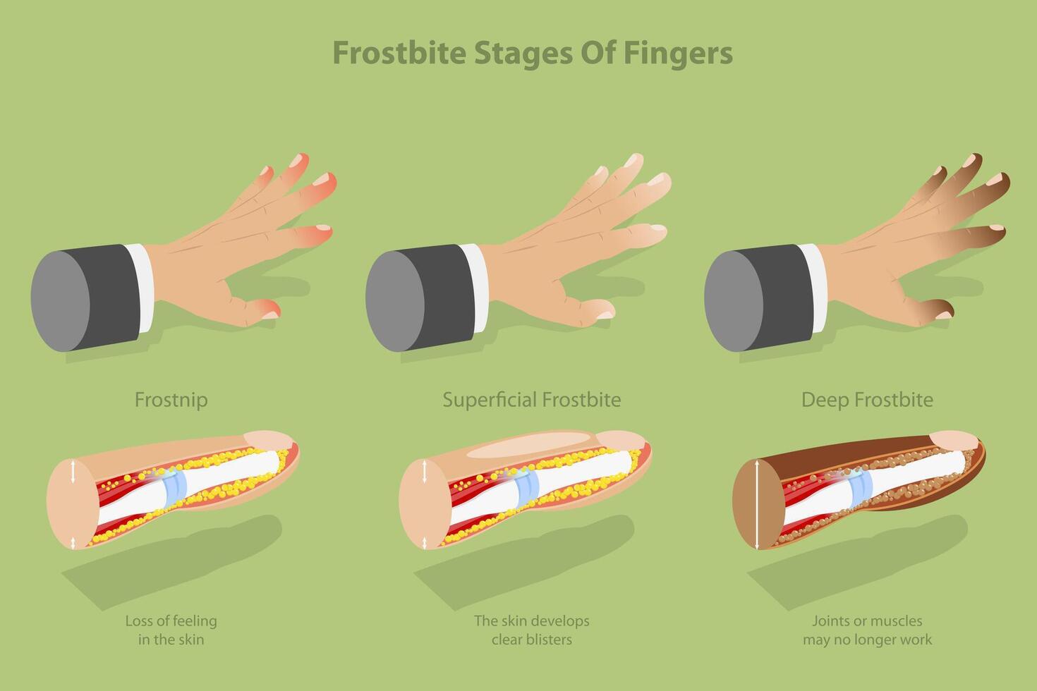 Stages of frostbite in fingers vector