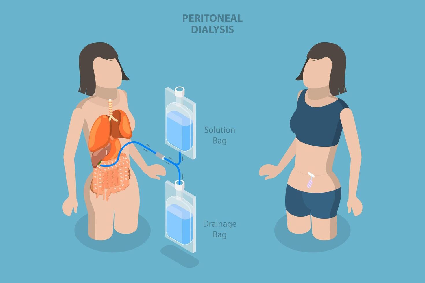 3D Isometric Flat Conceptual Illustration of Peritoneal Dialysis, Explanation Diagram vector