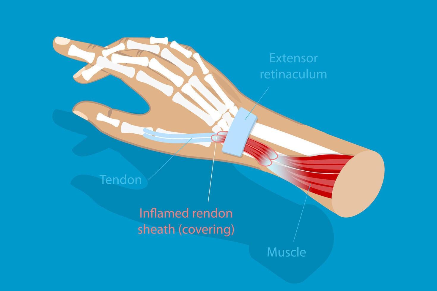 3D Isometric Flat Conceptual Illustration of De Quervain Syndrome, Occupational Disease of the Hand vector
