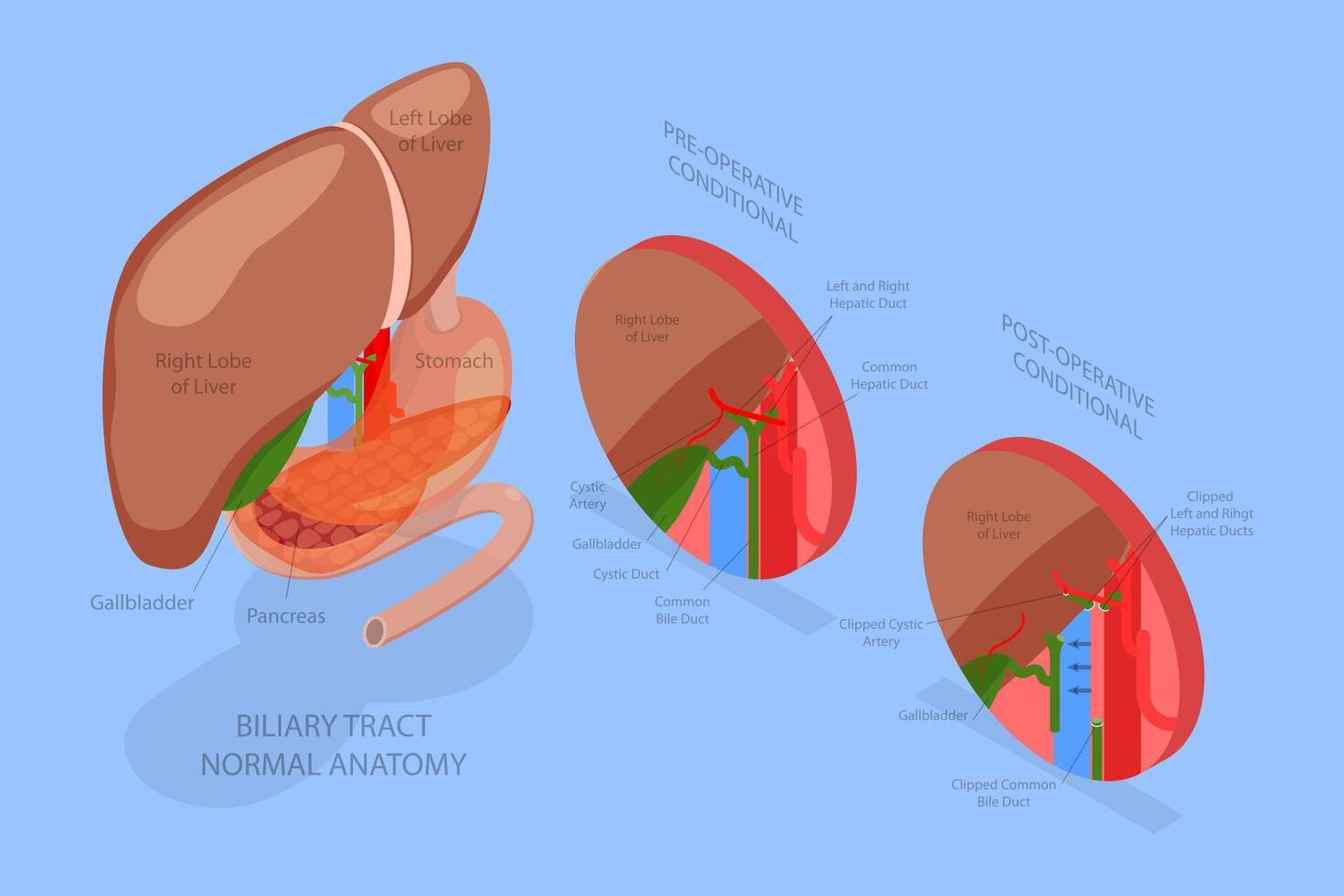 3D Isometric Flat Conceptual Illustration of Gallbladder Removal Surgery, Cholecystectomy vector