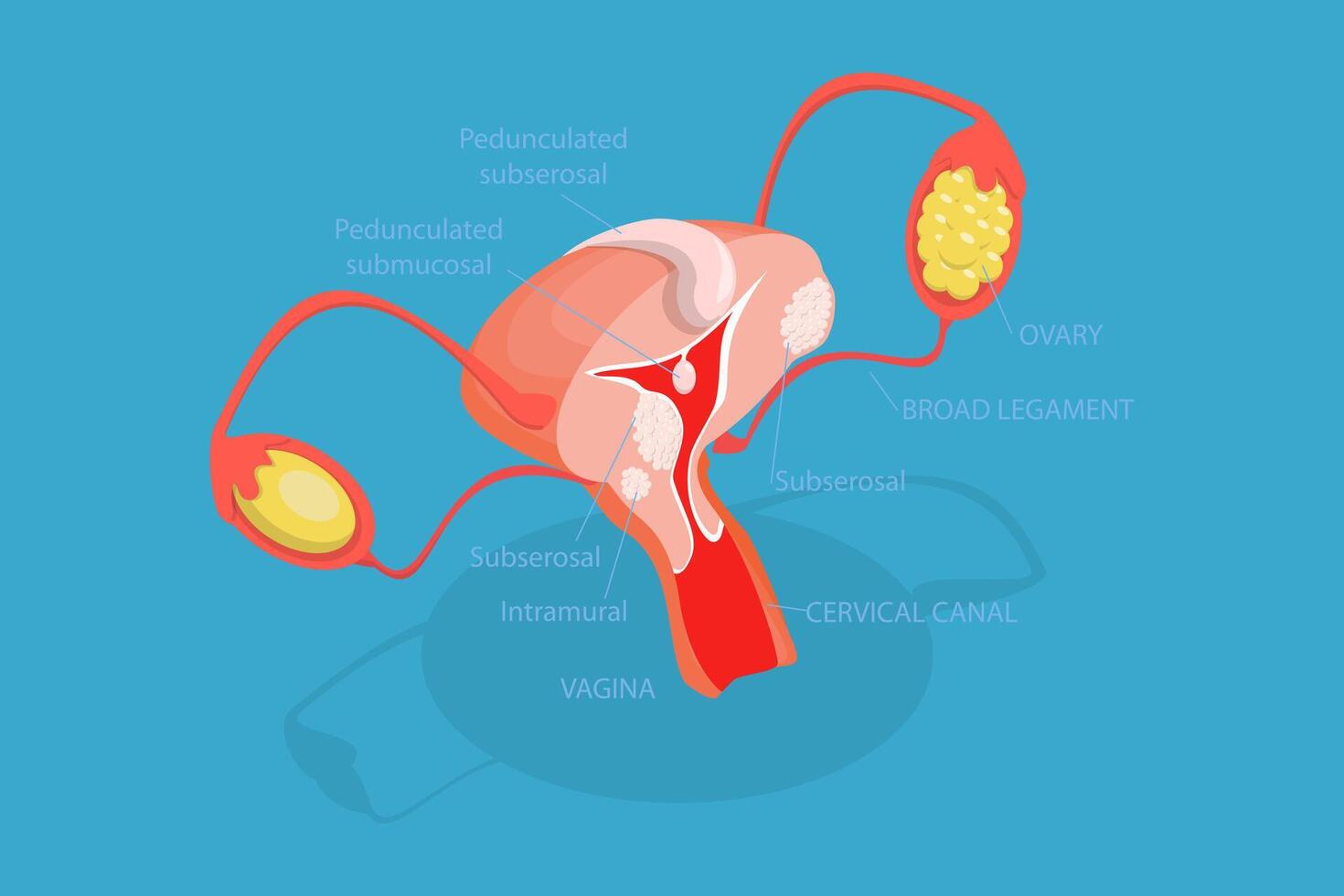3D Isometric Flat Conceptual Illustration of Types Of Uterine Fibroids, Human Anatomy vector